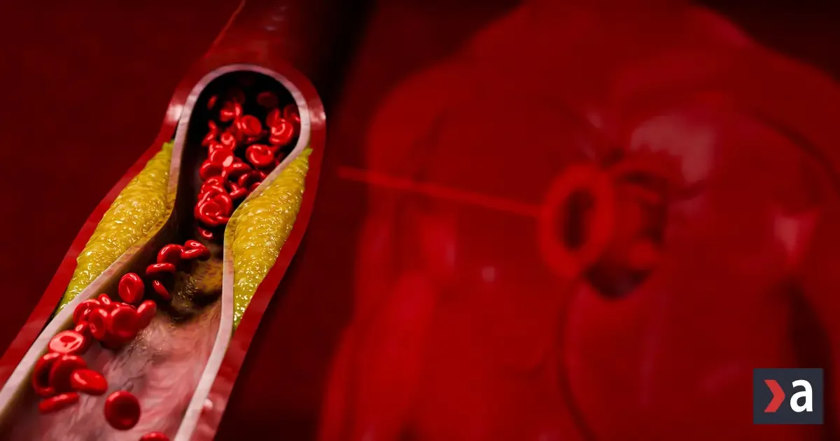 Tiché príznaky na pokožke, očiach a šľachách: Ako rozpoznať vysoký cholesterol včas?